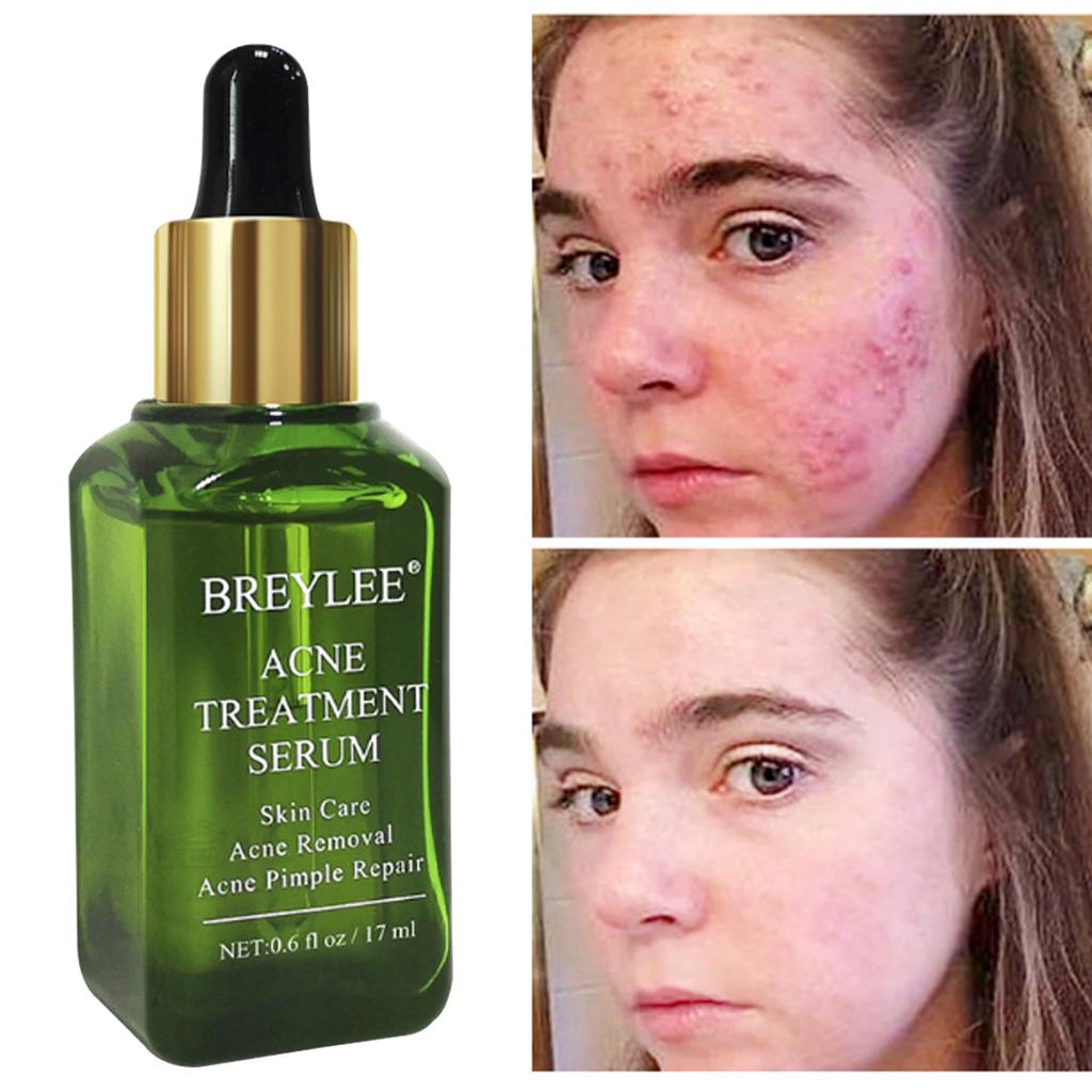 Acne Treatment Serum Cut Price BD